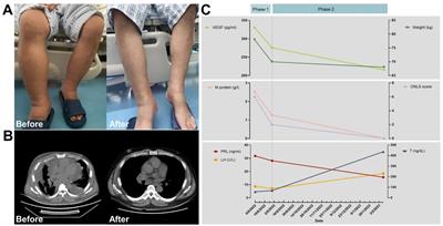 Case report: Atypical POEMS syndrome without polyneuropathy, complicated by borderline TAFRO syndrome